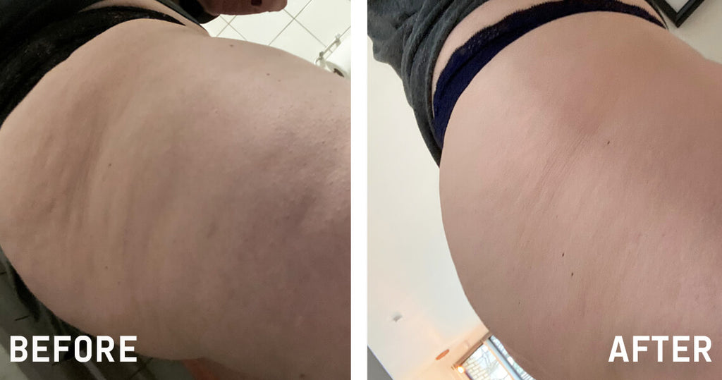 NADJA NOTICED SIGNIFICANTLY LESS CELLULITE!